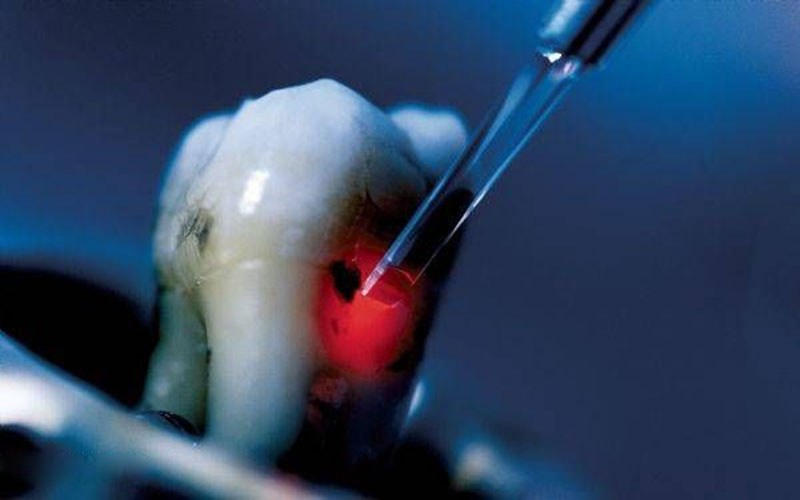 traiter les dents par laser rouge